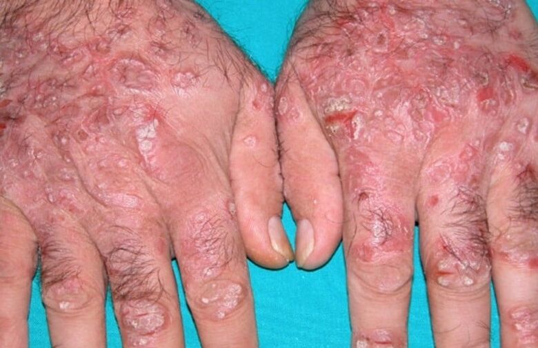 tränenförmige Psoriasis an den Händen