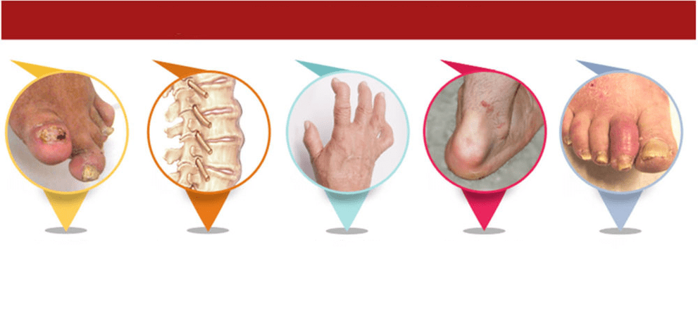 Arten von Psoriasis-Arthritis