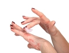 psoriasis auf den Händen
