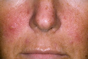 Symptome der psoriasis im Gesicht