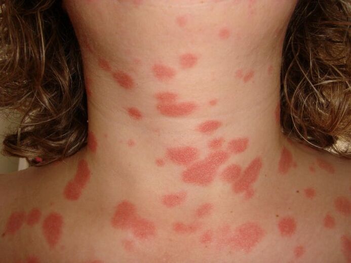 Psoriasis-Plaques auf der Haut. 