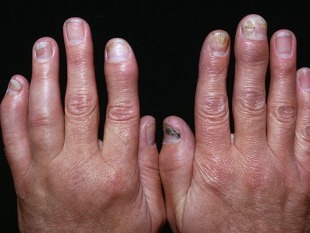 psoriasis-arthritis