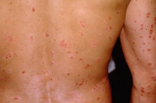 psoriasis Anfangsphase