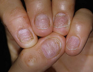psoriasis der Nägel